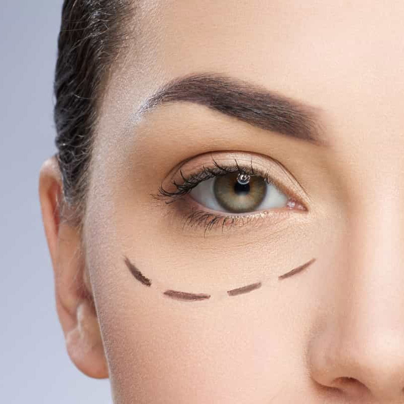 Blefaroplastia Em Fortaleza