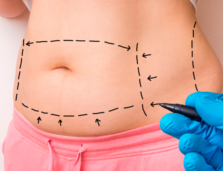 Cirurgia Plástica depois da gravidez. Posso fazer uma cirurgia plástica depois do parto?