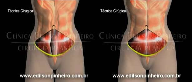 músculos abdominais na abdominoplastia