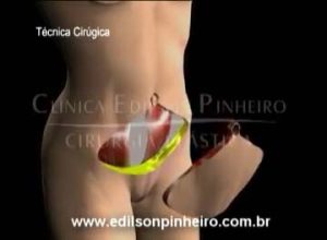 pele retirada na abdominoplastia