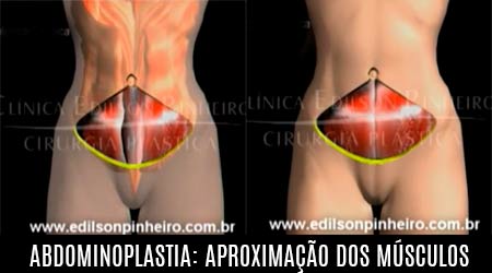 Reaproximação dos músculos na abdominoplastia