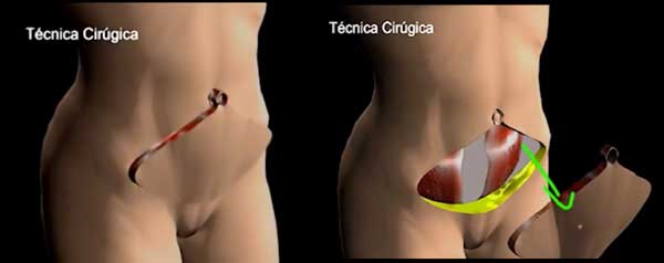 Umbigo e Abdominoplastia Completa:  como fica o umbigo depois da abdominoplastia?