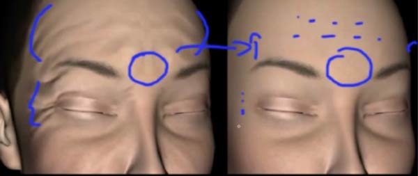antes e depois do Botox