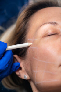 Tratamento estética pra prevenir o envelhecimento do rosto