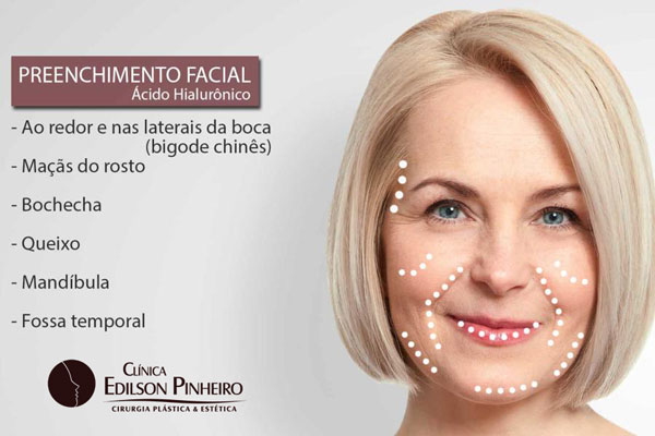 Áreas de aplicação do Preenchimento Facial