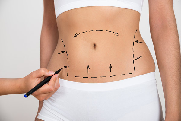 Abdominoplastia com Lipoaspiração, é possível fazer as duas cirurgias plásticas ao mesmo tempo?