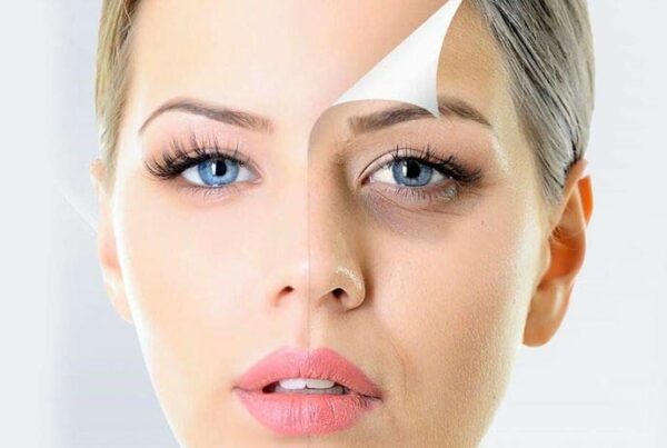 Tratamento para olheiras sem cirurgia