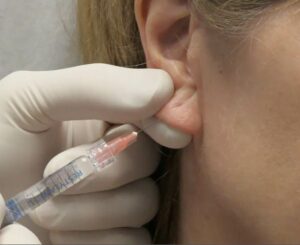 tratamento com ácido hialurônico no lóbulo da orelha 