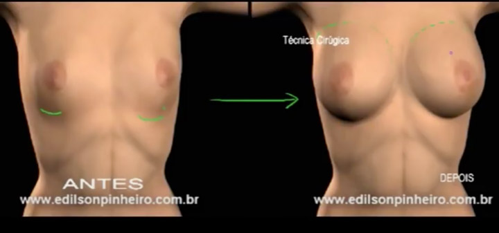 imagem de antes e depois de cirurgia de prótese de silicone em Fortaleza